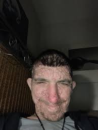 Introduction to Neurofibromatosis Community