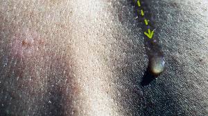 Image result for Sweat Chloride