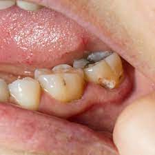Black Teeth The Causes And Treatments The Dental Centre London