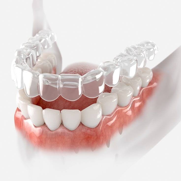 Invisalign Aligners for Under Bite product image