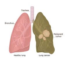 Treatments are available to decrease signs and symptoms and to help you live avoid taking large doses of vitamins in pill form, as they may be harmful. Lung Cancer Symptoms Causes And Treatment Of Lung Cancer