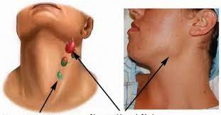 Symptoms include enlarged lymph nodes, fever, night sweats. E Bine SÄƒ È™tii Ce BoalÄƒ CruntÄƒ Poate Indica MÄƒrirea Ganglionilor È™tiri BotoÈ™ani SÄƒnÄƒtate Stiri Botosani Ro