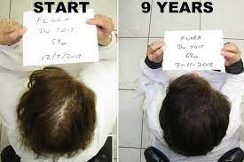This site is to showcase successful hair restoration results only. Dr Alexander Hairloss