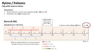 6 unntak høyre grenblokk kriteria kan ikke brukes dersom grenblokk wpw/preeksitasjon ekg ved akutt hjerteinfarkt hjerteinfarkt og ischemi 1. Forandringer Som Kan Skje Med De Enkelte Ekg Komponentene