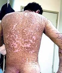 Image result for scabies norvegica