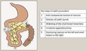 Image result for Intestinal Malrotation