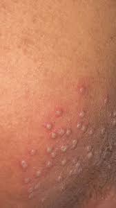 Does anyone know what this could possibly be?? It hurts to walk, sit, even  lay down. Its very uncomfortable:( : rDermatologyQuestions