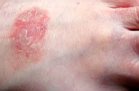 We did not find results for: J Ai Une Ou Des Taches Rouges Des Rougeurs Sur La Peau Planete Sante