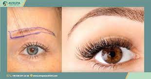 Eyebrow transplantation is done under local anaesthesia and the operation lasts for approx. Eyebrows Transplantation Get The Real You Back Avrupa Sac Ekimi