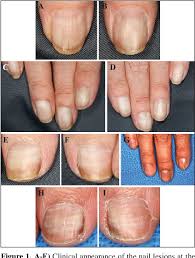 Image result for Muehrcke Line