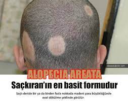 sackiran tedavisi icin uygulayabileceginiz 5 etkili yontem