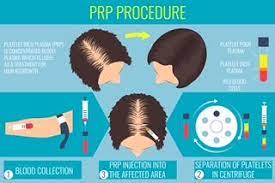 With All Of The Media Talking About Prp Dr Monte Slater Helps Your See The Truth About Prp Inject Prp Hair Loss Treatment Hair Loss Cure Platelet Rich Plasma