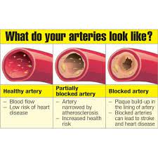 Plaque consists of calcium, fat, cholesterol and cellular waste. Arterial Cleansing Dissolve Remove Dangerous Arterial Plaque Safely