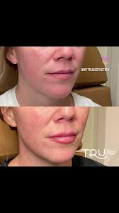 This was her Christmas gift, what's yours? 💋, “The little aesthetics  boutique, making a big difference.”, TRU Aesthetics, ☎️(813)696-1710,  💻www.mytruaesthetics.com , 📍1218 Millennium Pkwy ste 2-14 ...