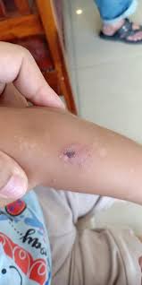 Ubat kurap paling mujarab, ubat kurap cap kaki tiga, ubat kurap, ubat kurap kucing, ubat kurap pada payudara, ubat kurap tradisional, ubat kurap manusia, ubat kurap sayuran, ubat kurap di. Kalau Lambat Buat Rawatan Mungkin Buta Sebelah Mata Anak Terkena Jangkitan Kuman Dari Kucing Kurap The Reporter