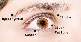 Tests that examine the sinuses and nasal cavity are used to diagnose paranasal sinus and nasal cavity cancer. 10 Health Problems Your Eyes Could Be Showing Signs Of Sunshine Optometry