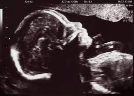 Wie lange sollte der gebärmutterhals in der 34. Dopplersonographie Doppler Ultraschall In Der Schwangerschaft 9monate De