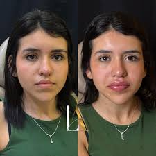 Trazendo harmonia para os lábios de forma delicada e natural! 💋✨❤️‍🔥 . .  . Dra. Lara Antonelli