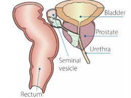 That has not happened with screening for breast and prostate cancer. Prostate Cancer Irish Cancer Society