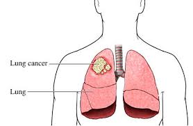 Image result for Lung Cancer