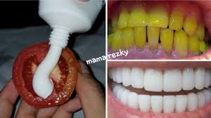 Cara alami memutihkan gigi kuning dengan baking soda: Teeth Whitening At Home In 2 Minutes Meutihkan Gigi Di Rumah Dalam 2 Menit Mama Rezky Youtube