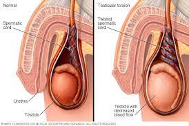 And i don't produce as much product. Testicular Torsion Symptoms And Causes Mayo Clinic