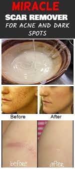 Miracle Homemade Scar Remover For Acne And Dark Spots Scar Removal Scar Remedies Acne