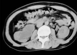 Image result for Perinephric Abscess