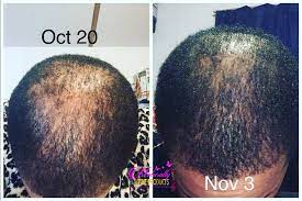 Yulia reznikov / getty images. Pin On Hair Growth Before After