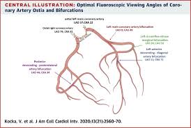 It is a diagonal artery simply because it runs diagonally the exact number of arteries in any one person are determined by genetics. Optimal Fluoroscopic Projections Of Coronary Ostia And Bifurcations Defined By Computed Tomographic Coronary Angiography Sciencedirect