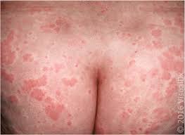 Image result for Papular urticaria