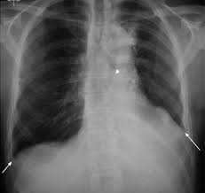 Pleural aspergillosis in a patient with recurrent spontaneous pneumothorax: Bilateral Pneumothorax Resulting From A Diagnostic Thoracentesis European Respiratory Society