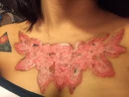 Keloid removal treatment works by shrinking the keloid. Thai Student Left With Horrific Scars After Tattoo Removal Daily Mail Online