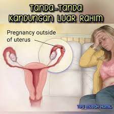 Mengandung luar rahim turut dikenali sebagai ectopic pregnancy (kehamilan ektopik). Jom Usaha Hamil Tanda Tanda Kandungan Luar Rahim Facebook