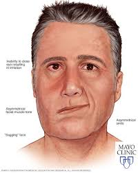 Sidan redigerades senast den 13 juli 2019 kl. Herpes Zoster I Orat Yrsel Com