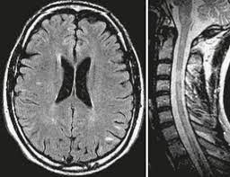 Diffusion weighted imaging, magnetic resonance imaging, osmotic demyelination. Multiple Sclerosis And Other Idiopathic Inflammatory Demyelinating Diseases Radiology Key