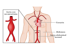 Da quali sintomi si riconosce? Los Pacientes Con Aneurisma Aortico Abdominal Ven Reducida La Funcion Cardioprotectora Del Colesterol Hdl