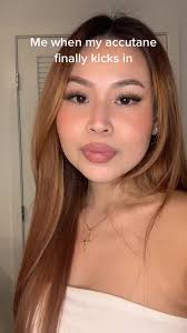 Accutane Purge Journey: My Experience Explained