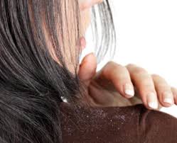 Kelemumur ataupun dandruff sangat merimaskan. Usah Risau Ada Kelemumur Buat Je Petua Ni Kasi Lenyap Semua Mudah Paling Penting Berkesan Keluarga