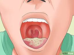 التعرف على أعراض فيروس نقص المناعة المكتسبة wikihow