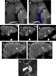 Atypical Covid 19 Presentation With Budd Chiari Syndrome Leading To An Outbreak In The Emergency Department The American Journal Of Emergency Medicine