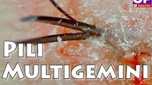 You can take a clean toothbrush dipped in little water and brush the this can lead to multiple ingrown hairs growing out of one pore. Pili Multigemini Multiple Sets Of Ingrown Hairs Growing Out Of The Same Follicle Youtube