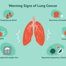 Lung cancer doesn't always cause symptoms in its early stages. Is My Cough A Lung Cancer Cough