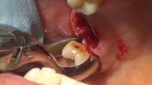 Loose tooth always takes some time till it fallout. How To Pull Tooth Youtube