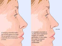 Retracted And Hanging Columella ˌkɒl Yəˈmɛl I Rhinoplasty Nose Surgery Nose