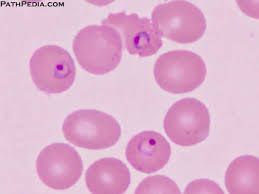 The word malaria with the assorted pills and capsules on white background. Histopathology Images Of Malaria By Pathpedia Com Pathology E Atlas