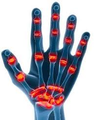Fingerarthrose Bei Arthrose Der Fingergelenke Gibt Es Zahlreiche Hilfen Www Gelenk Doktor De