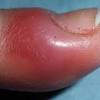 Read about oral herpes symptoms, outbreak stages, signs, treatment, transmission, and prevention. Https Encrypted Tbn0 Gstatic Com Images Q Tbn And9gctyok1g5tfv0ygxz Dyealmaolql3rzutsdzfone2djt505mfvr Usqp Cau