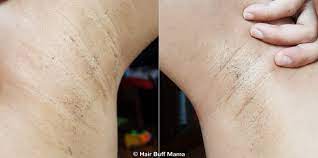 Variety of products remington has a large number of hair related products on the market. Remington Ilight Ultra An Honest Review Before After Pics