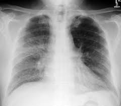 Unilateral Pulmonary Edema In Diastolic Heart Failure Radiology Case Radiopaedia Org 'acute heart failure' has been criticised as an imprecise term that has consistently defied a consensus definition, with disparate interpretations. unilateral pulmonary edema in diastolic